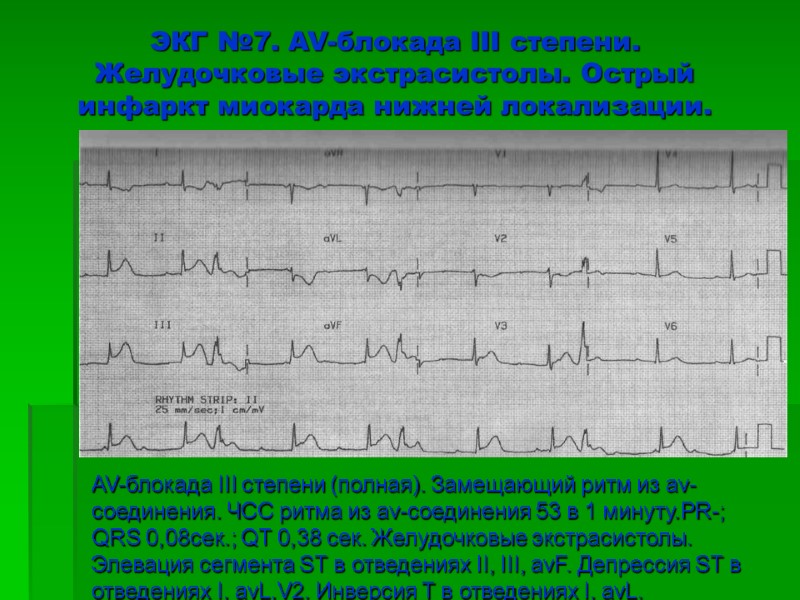 ЭКГ №7. AV-блокада III степени. Желудочковые экстрасистолы. Острый инфаркт миокарда нижней локализации.  